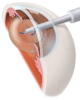 Cataract Treatment | Cataract Surgery Fishkill NY | Poughkeepsie NY