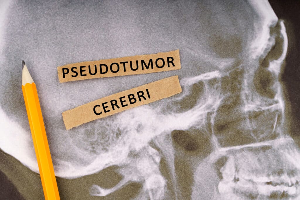 1761098012_Pseudotumor-cerebri-treatment