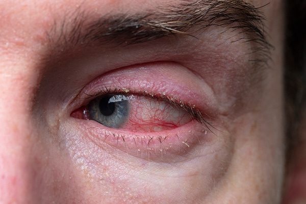 1761099702_peal-Blepharitis